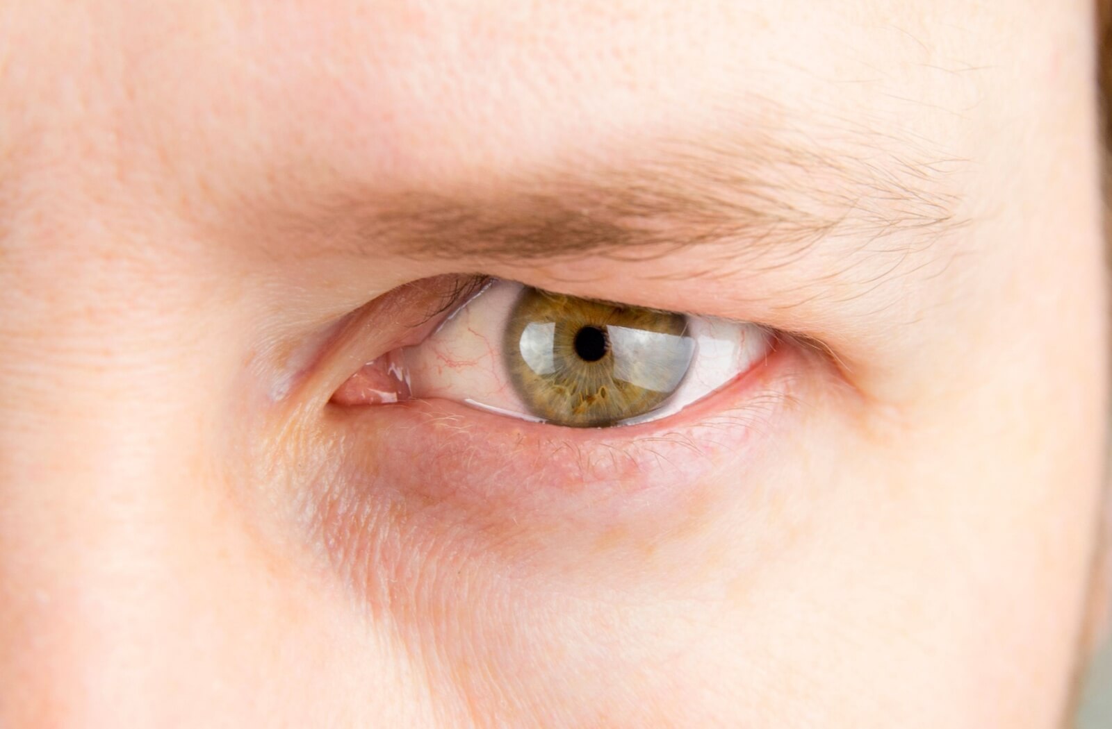 A close-up image of an adult's eye and droopy eyelid.