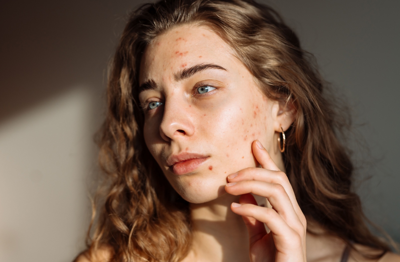A portrait of a young adult with moderate acne.